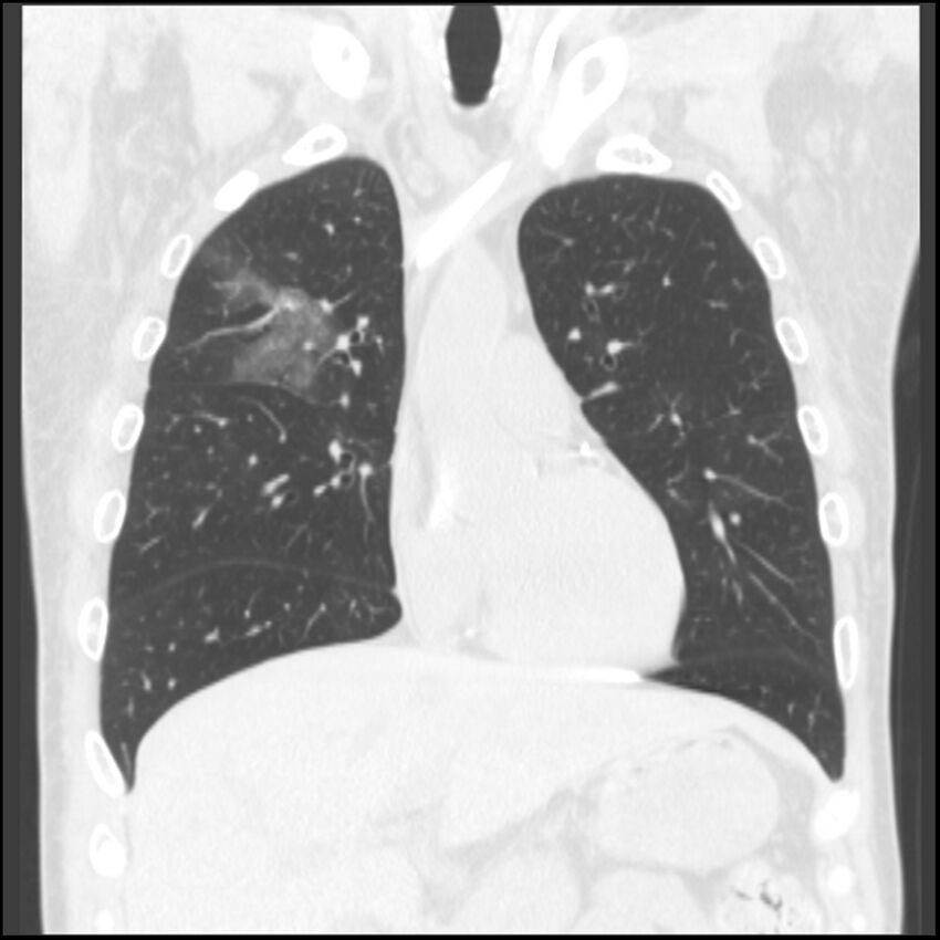 Angioinvasive aspergillosis (Radiopaedia 43957-47466 Coronal lung window 61).jpg