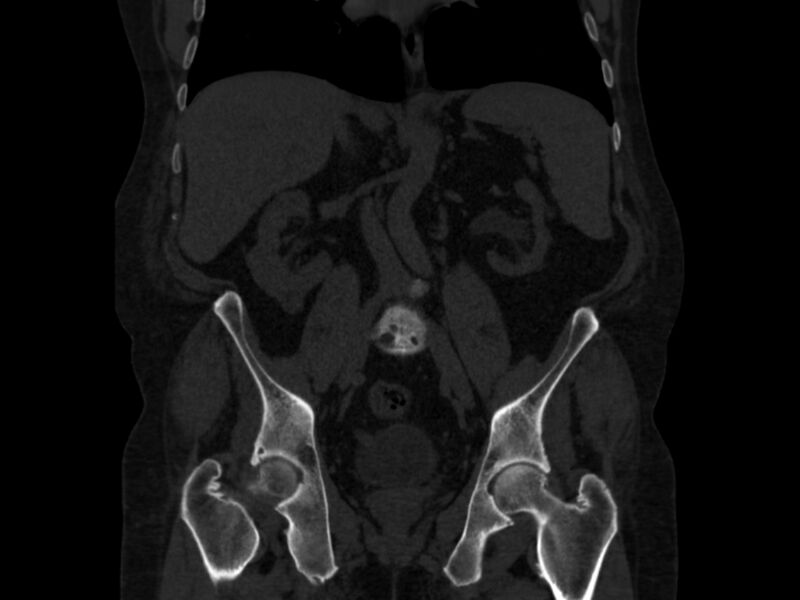 File:Ankylosing spondylitis (Radiopaedia 44609-48357 Coronal bone window 39).jpg