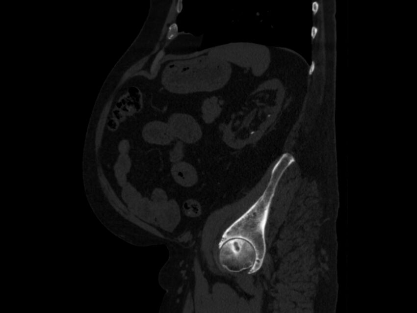 Ankylosing spondylitis (Radiopaedia 44609-48357 Sagittal bone window 83).jpg