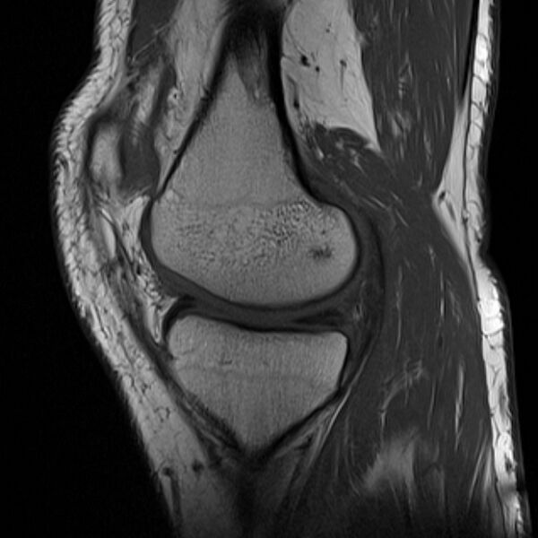 File:Anterior cruciate ligament tear - ramp lesion (Radiopaedia 71883-82322 Sagittal T1 17).jpg
