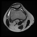 Anterior cruciate ligament tear with posteromedial corner injury, bucket-handle meniscal tear and chondral delamination (Radiopaedia 75501-86744 Axial T2 20).jpg
