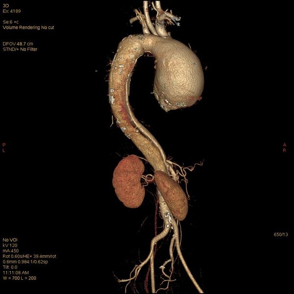 File:Aortic dissection (Radiopaedia 25350-25604 E 13).jpg