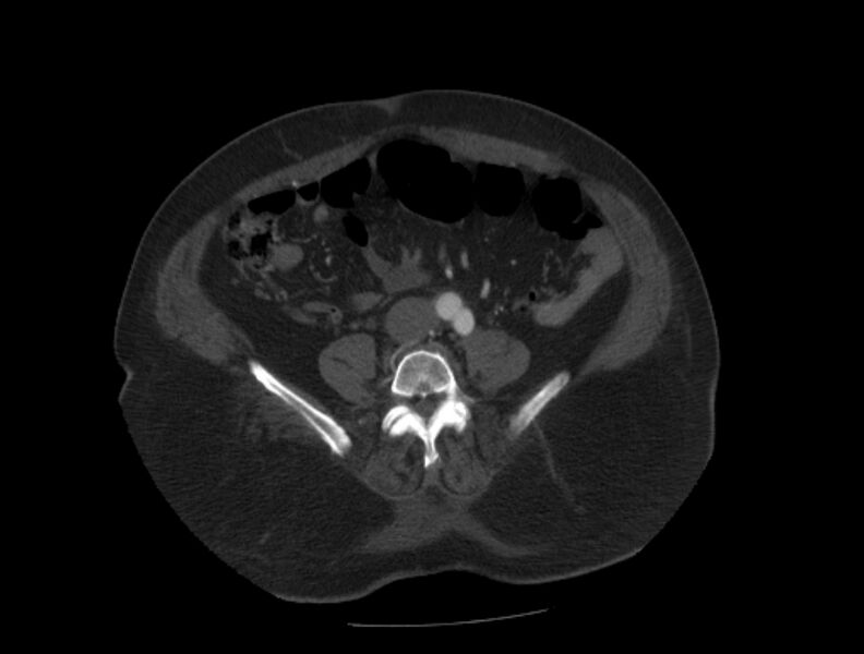 File:Aortic dissection (Radiopaedia 28802-29105 A 77).jpg