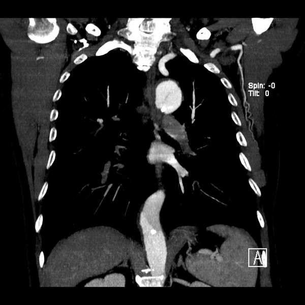File:Aortic dissection - De Bakey type III - Stanford B (Radiopaedia 21903-21882 C 14).jpg