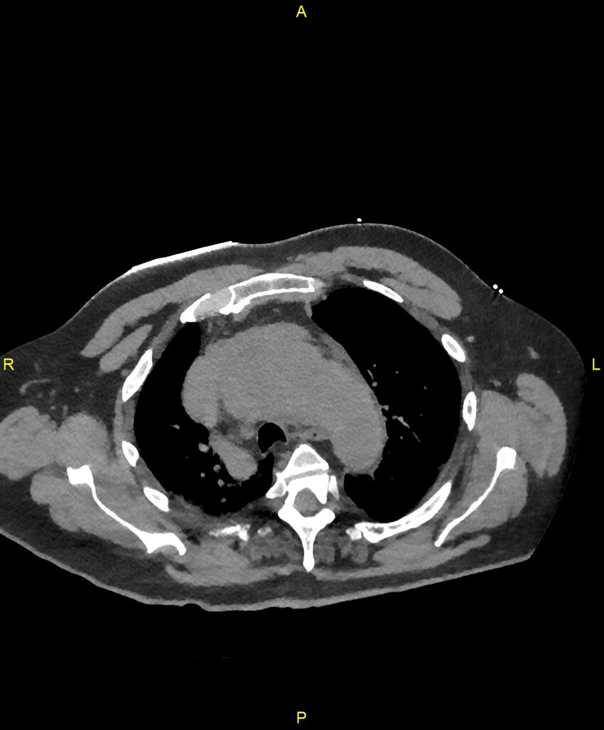 Aortic rupture (Radiopaedia 88822-105594 Axial non-contrast 52).jpg