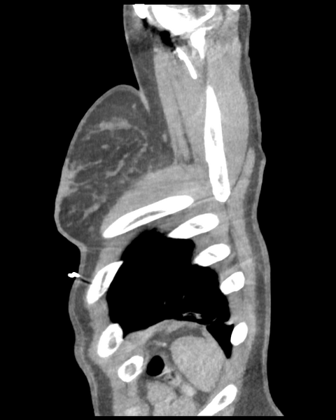 File:Aortic valve non-coronary cusp thrombus (Radiopaedia 55661-62189 D 5).png