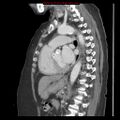 Aortic valve stenosis (Radiopaedia 14480-14423 B 6).jpg