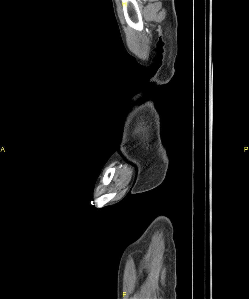 Aortoenteric fistula (Radiopaedia 84308-99603 C 5).jpg