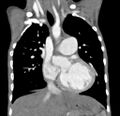 Aortopulmonary window, interrupted aortic arch and large PDA giving the descending aorta (Radiopaedia 35573-37074 D 30).jpg
