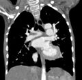 Aortopulmonary window, interrupted aortic arch and large PDA giving the descending aorta (Radiopaedia 35573-37074 D 39).jpg