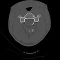 Apical pneumothorax on cervical spine CT (Radiopaedia 45343-49368 Axial bone window 33).jpg