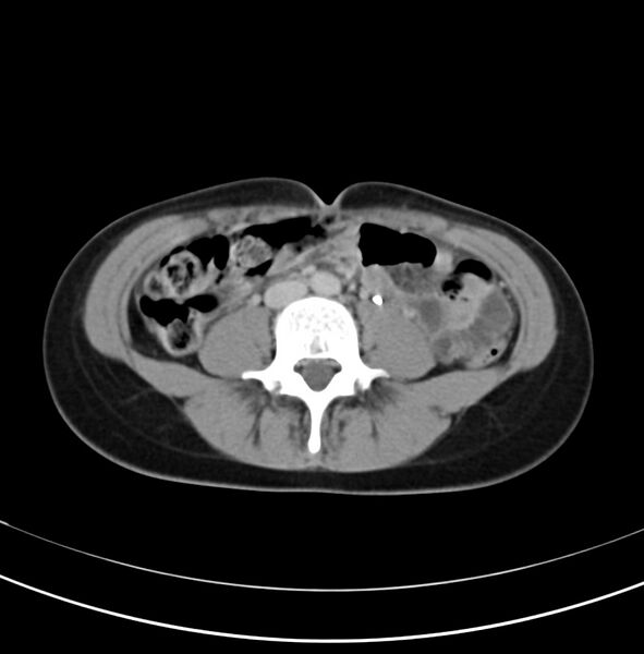 File:Appendicitis and incidental bicornuate uterus (Radiopaedia 22833-22853 Axial C+ delayed 20).jpg