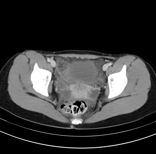 File:Appendicitis and incidental bicornuate uterus (Radiopaedia 22833-22853 B 42).jpg