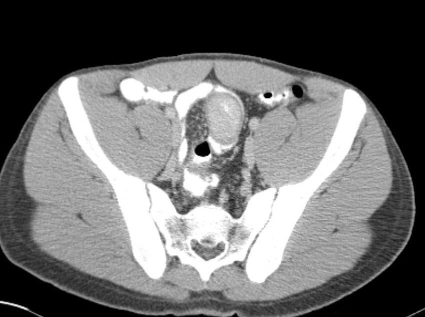 Appendicitis and incidental foregut duplication cyst (Radiopaedia 52962-58916 A 75).jpg