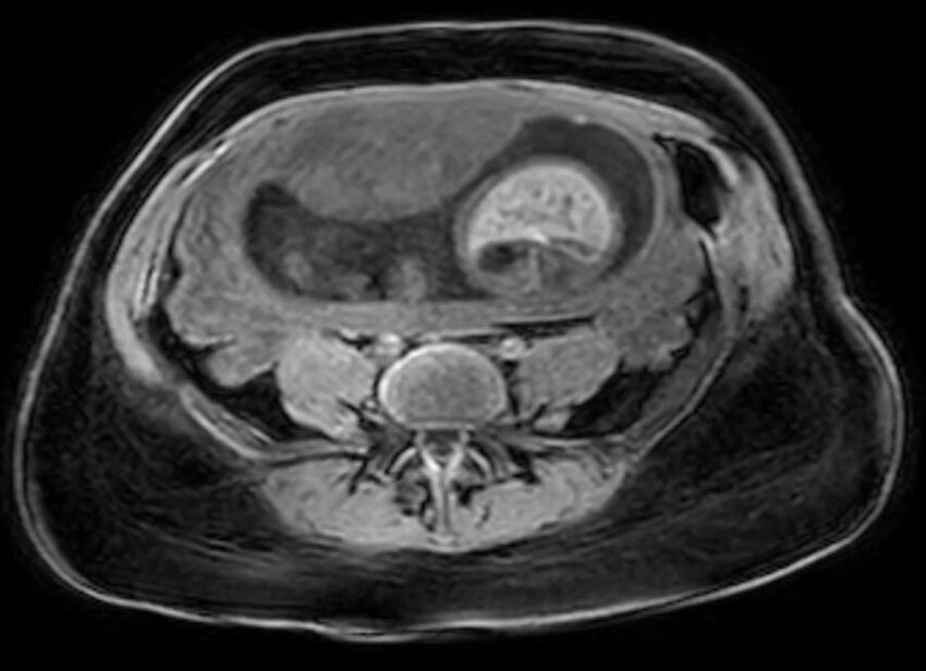 Appendicitis in gravida (MRI) (Radiopaedia 89433-106395 Axial DIXON 94).jpg