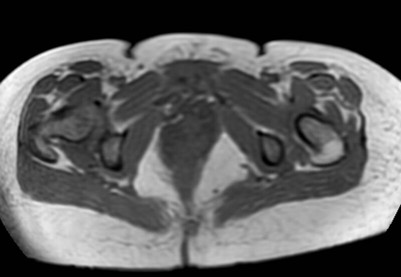 File:Appendicitis in gravida (MRI) (Radiopaedia 89433-106395 Axial T1 in-phase 70).jpg