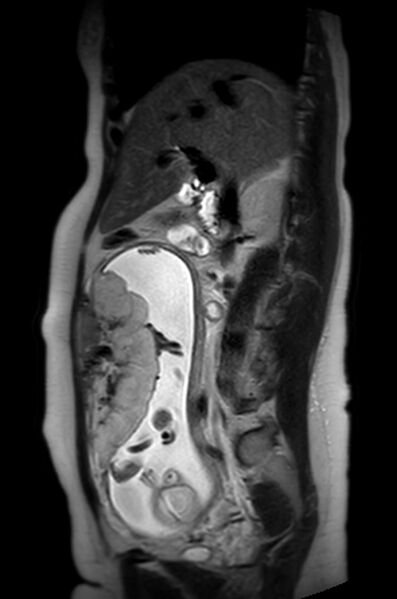 File:Appendicitis in gravida (MRI) (Radiopaedia 89433-106395 Sagittal T2 39).jpg