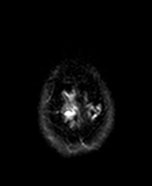 File:Arachnoid cyst- extremely large (Radiopaedia 68741-78451 Axial DWI 25).jpg