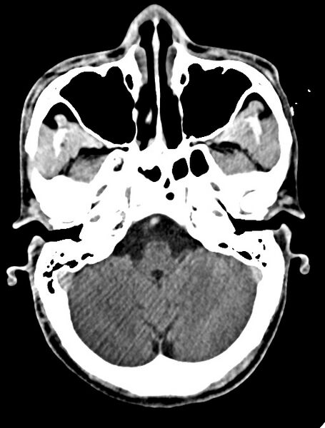 File:Arrow injury to the face (Radiopaedia 73267-84011 Axial C+ delayed 38).jpg