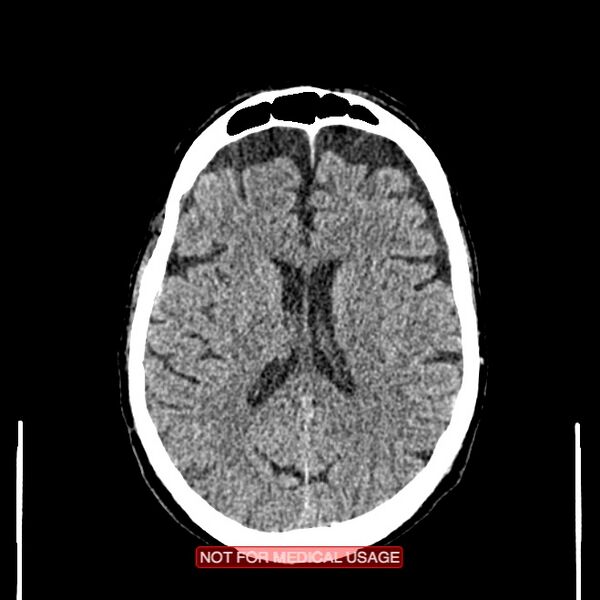 File:Artery of Percheron infarction (Radiopaedia 28679-28967 Axial non-contrast 71).jpg