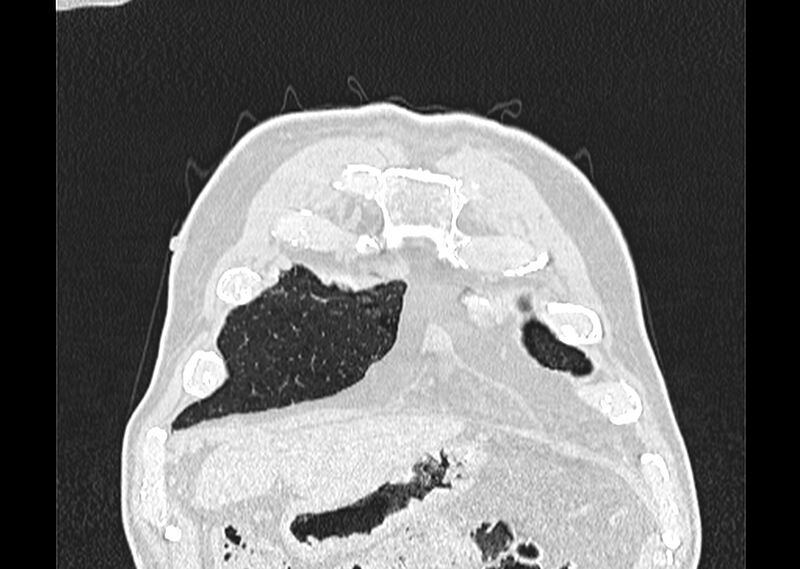 File:Asbestos pleural placques (Radiopaedia 57905-64872 Coronal lung window 17).jpg