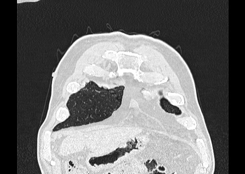 Asbestos pleural placques (Radiopaedia 57905-64872 Coronal lung window 17).jpg
