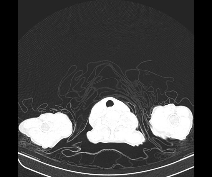 File:Aspergillomas (Radiopaedia 66779-76110 Axial lung window 4).jpg