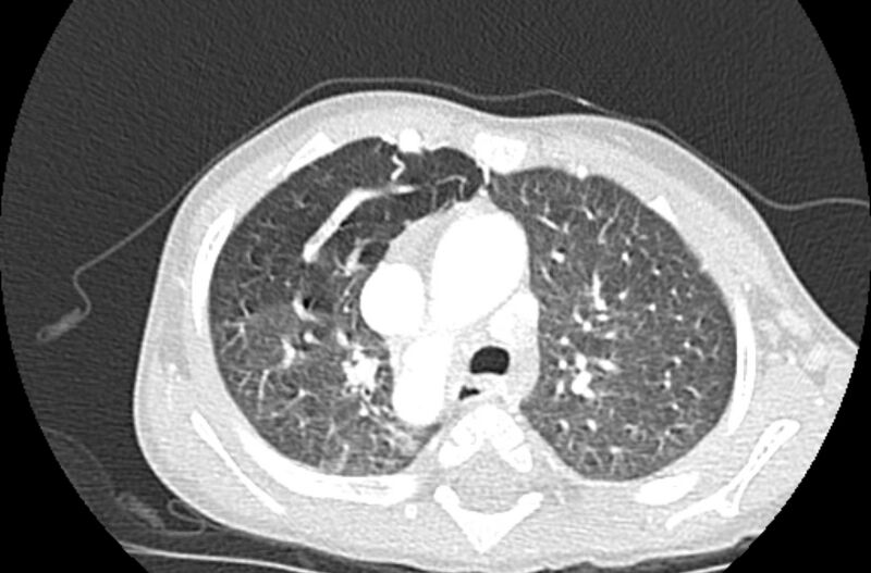 File:Asplenia syndrome (Radiopaedia 73083-83792 Axial lung window 21).jpg