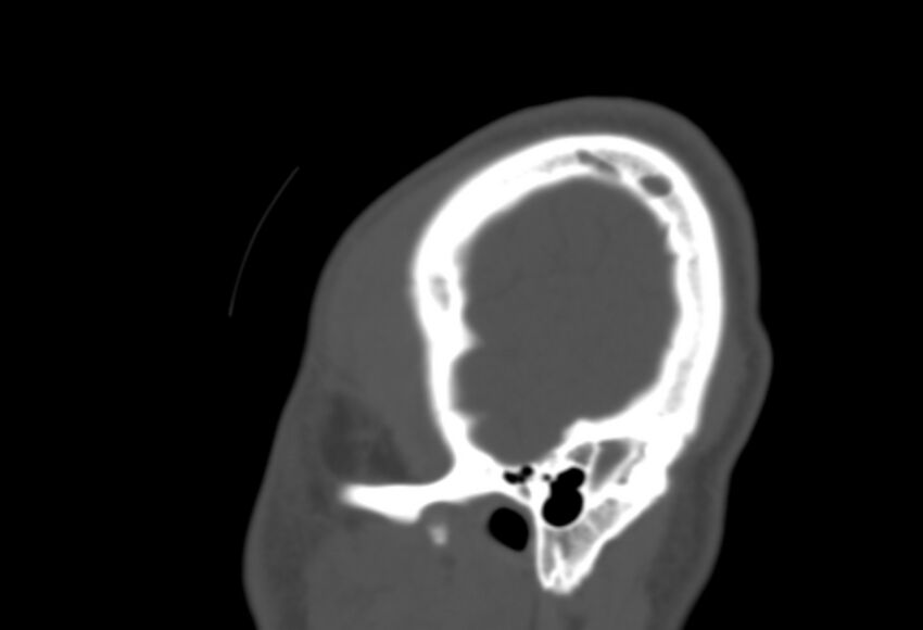 Asymptomatic occipital spur (Radiopaedia 87753-104201 Sagittal bone window 295).jpg
