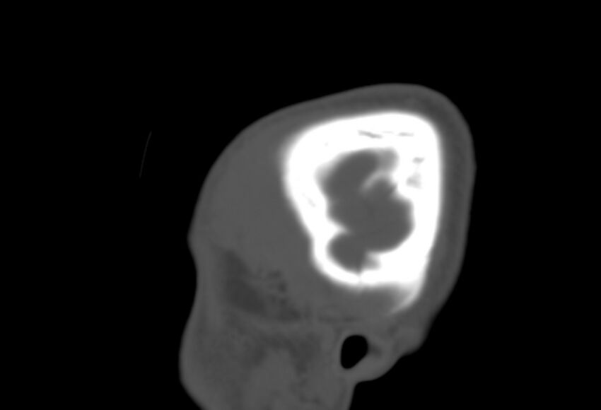 Asymptomatic occipital spur (Radiopaedia 87753-104201 Sagittal bone window 6).jpg