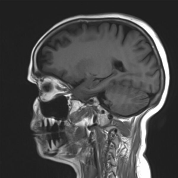 File:Atlanto-occipital assimilation with basilar invagination (Radiopaedia 70122-80157 Sagittal T1 8).jpg