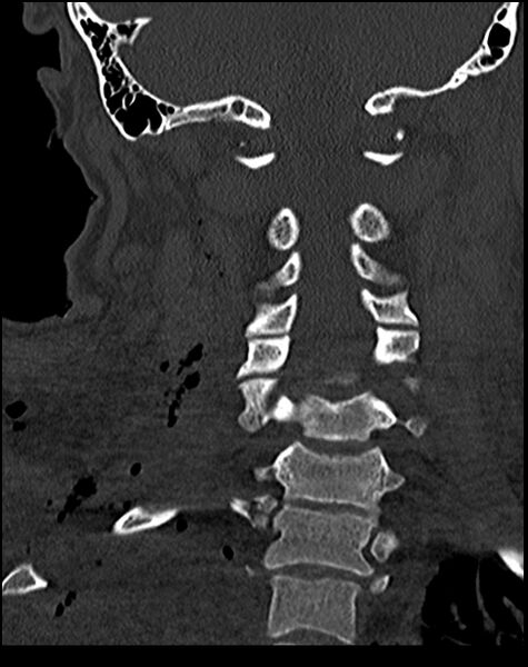 File:Atlanto-occipital dissociation - Traynelis type 1 (Radiopaedia 87570-103948 Coronal bone window 37).jpg