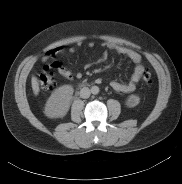 File:Atrophic kidney due to severe chronic obstructive hydronephrosis (Radiopaedia 40828-43474 Axial non-contrast 12).jpg