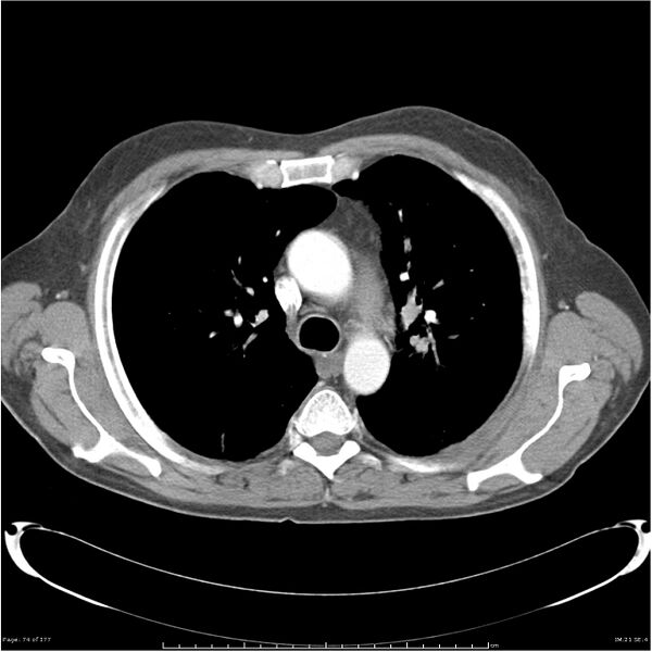 File:Atypical pneumonia - Q fever (Radiopaedia 21993-21989 C+ arterial phase 16).jpg