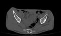 Avascular necrosis of the left hip (Radiopaedia 75068-86125 Axial bone window 1).jpg