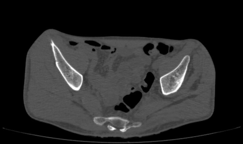 File:Avascular necrosis of the left hip (Radiopaedia 75068-86125 Axial bone window 1).jpg