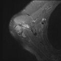 Avulsion fracture - greater tuberosity of humerus (Radiopaedia 71216-81515 Axial PD fat sat 17).jpg
