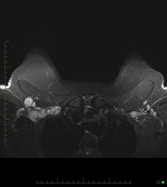 File:Axillary lymphadenopathy on breast MRI- yellow fever vaccination induced (Radiopaedia 19454-19483 Axial T2 fat sat 2).jpg