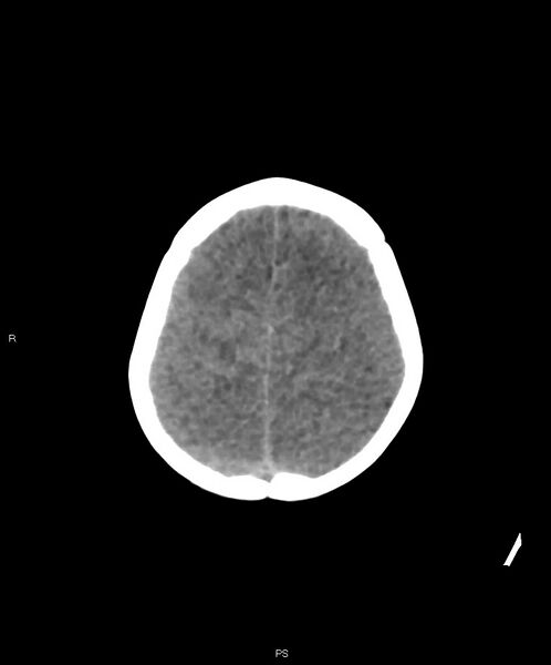 File:Basal ganglia and parenchymal ischemia (Radiopaedia 45818-50083 Axial non-contrast 7).jpg