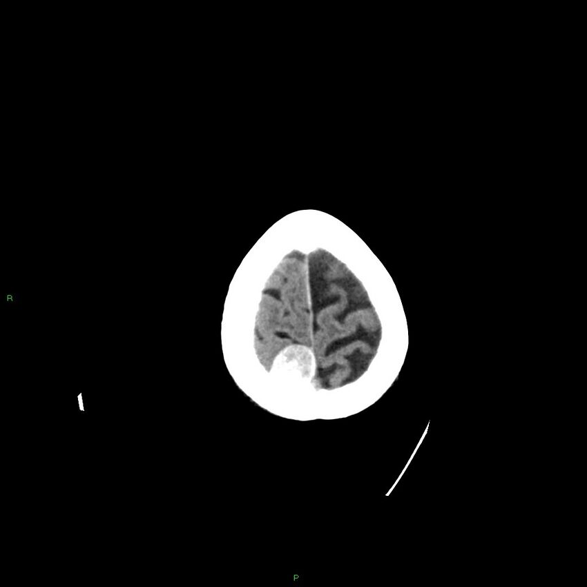 Basal ganglia hemorrhage (Radiopaedia 58350-65473 Axial non-contrast 6).jpg