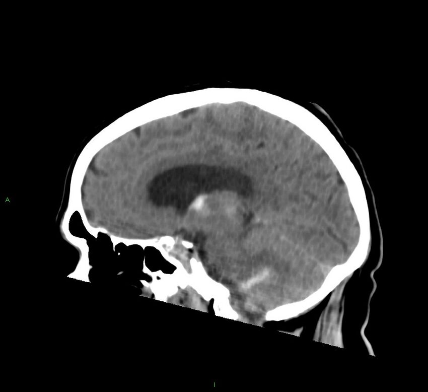 Basal ganglia hemorrhage (Radiopaedia 58763-65985 C 36).jpg