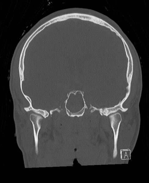 File:Base of skull fracture with bilateral Le Fort fractures (Radiopaedia 47094-51638 Coronal bone window 52).jpg