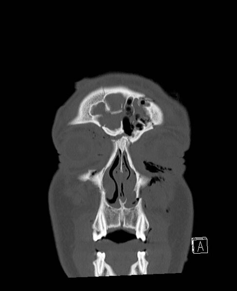 File:Base of skull fracture with bilateral Le Fort fractures (Radiopaedia 47094-51638 Coronal bone window 86).jpg