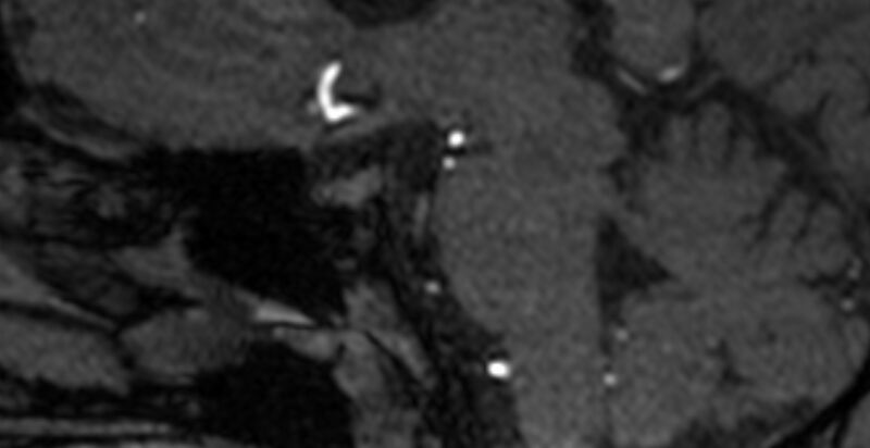 File:Basilar artery fenestration (Radiopaedia 74537-85455 Sagittal MRA TOF 10).jpg