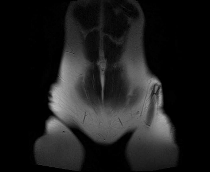 File:Bicornuate bicollis uterus (Radiopaedia 61626-69616 Coronal T2 1).jpg