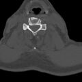 Bilateral C6-7 locked facet dislocation (Radiopaedia 28506-28748 Axial bone window 13).jpeg