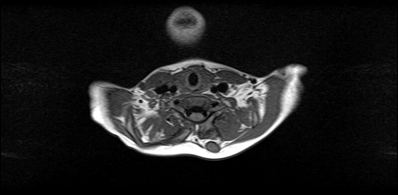 File:Bilateral Sprengel deformity with Klippel-Feil syndrome (Radiopaedia 66395-75650 Axial T1 15).jpg