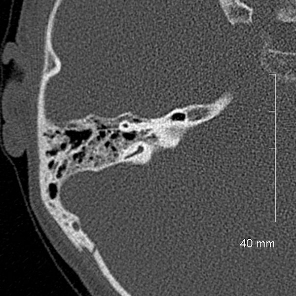File:Bilateral grommets (Radiopaedia 47710-52404 Axial bone window 52).jpg