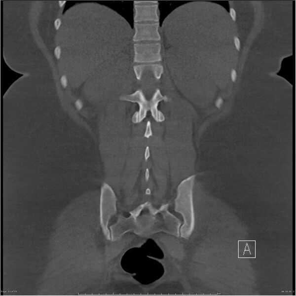 File:Bilateral lumbar ribs (Radiopaedia 25862-26010 Coronal bone window 17).jpg