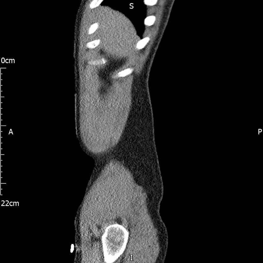 Bilateral medullary nephrocalcinosis with ureteric calculi (Radiopaedia 71269-81569 C 104).jpg